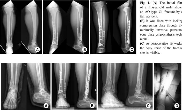 Fig. 1. (A) The initial film  of a 51-year-old male shows  an AO type C1 fracture by a  fall accident