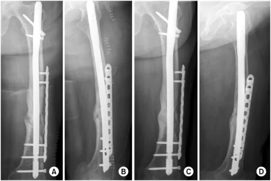 Fig. 5. (A, B) A fourth ope- ope-ration was performed with  ante-grade femur nail and locking  compression plate