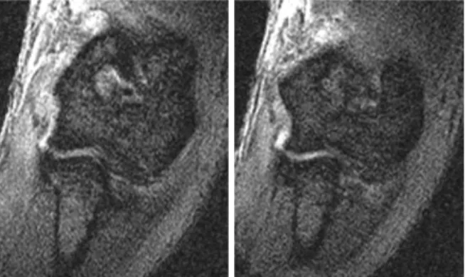 Fig. 2. Magnetic resonance imaging show high signal intensity  at the common flexor tendon and medial collateral ligament  lesion of the elbow.