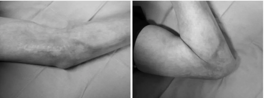 Fig. 7. At final follow up, a  patient presented with 25  de-grees of flexion contracture  without evidence of elbow  instability