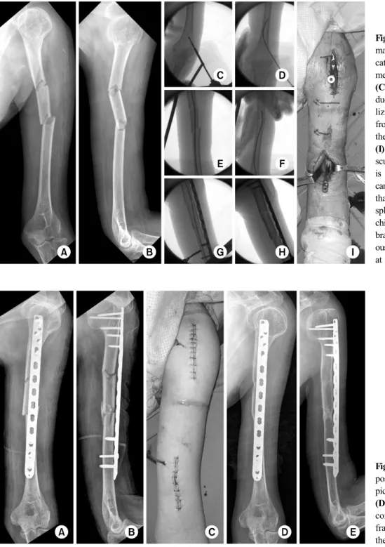 Fig. 4. (A, B) A 61-year-old  male with AO/OTA  classifi-cation C2 fracture of the  hu-merus
