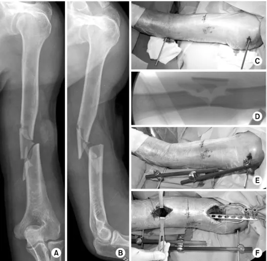 Fig. 6. (A, B) A 64-year-old  male showed comminuted  hu-merus shaft fracture of AO/ 