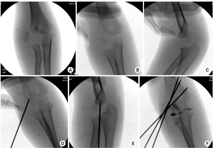Fig. 7. (A) Anteroposterior radiograph showing a completely displaced fracture with rotation of the fracture fragment