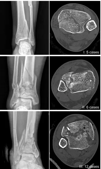Fig. 1. Twenty-three patients were classified by pre-operative  simple X-ray and computed tomography scan using the  Rüedi-Allg ö wer 16)  classification in this study.