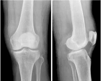 Fig. 1. Pre-operative radiographs show soft tissue swelling  without fracture around the distal femur.