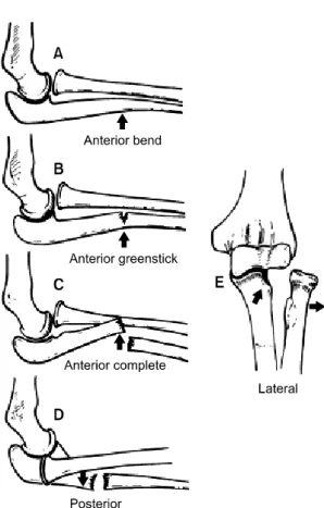 Fig. 1. Classification of pediatric Monteggia fracture-disloca- fracture-disloca-tions