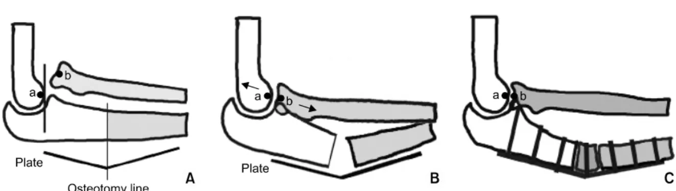 Fig. 4. Pre-operative paper tracing for ulnar bending elongation osteotomy (modified Hirayama osteotomy)