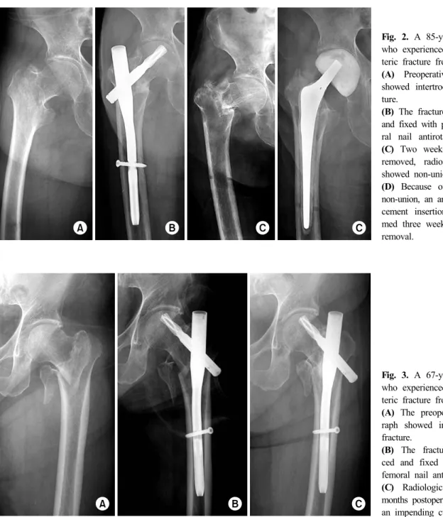 Fig. 2. A 85-year-old female  who experienced  intertrochan-teric fracture from a fall