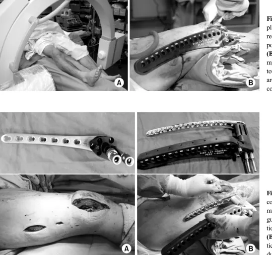 Fig. 1.  (A) Patients were  placed supine and the  uninju-red leg was in the loweuninju-red  position for fluoroscopy