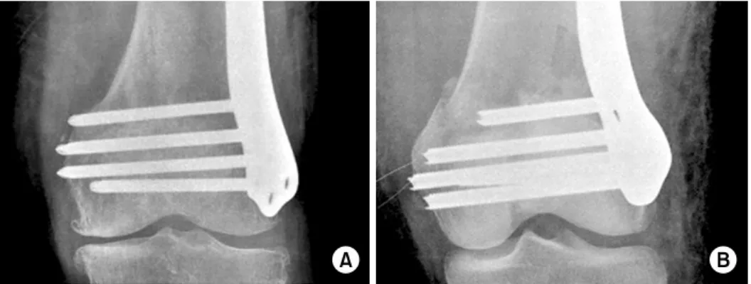 Fig. 6. The distal locking  screw penetrated the medial  femoral cortex in the (A)  locking compression plate in  distal femur group and (B)  Zimmer Ⓡ  periarticular locking  plate (ZPLP) group