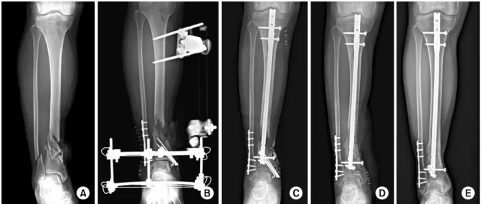 Fig. 1. A  31-year-old male with Gustilo-Anderson type II open fracture on his right tibia