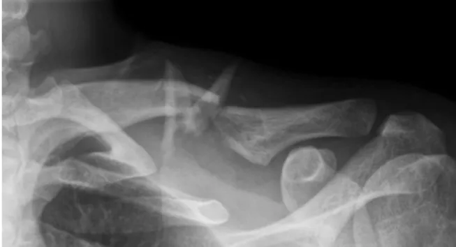 Fig. 1. Isolated segmental comminuted clavicle mid-shaft  fractures (Edinburgh classification type IIB2).