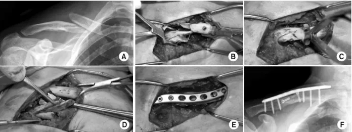 Fig. 2. (A) Preoperative radiograph.