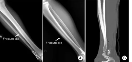 Fig. 2. Intraoperative photo shows that multiple drilling was  performed with a 2.5 mm drill bit after corticotomy