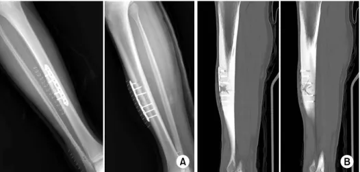 Fig. 3. (A) Plain radiographs  and  (B) computed tomograph  show the plate fixation with  corticotomy and multiple  dril-ling of the fracture site.