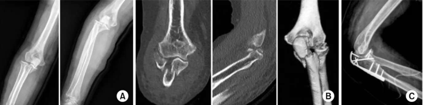 Fig. 5. (A) Subluxated radiocapitellar joint was observed despite manual reduction of terrible triad injury.