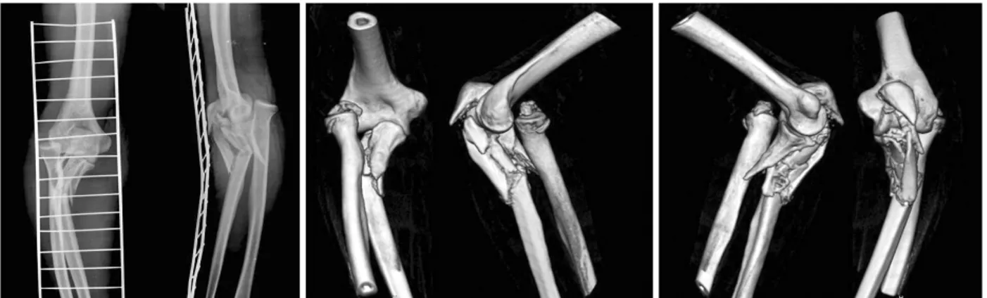 Fig. 6. Anteroposterior and lateral radiographs of an elbow fracture-dislocation that inadequately characterized the extent of  bony injury