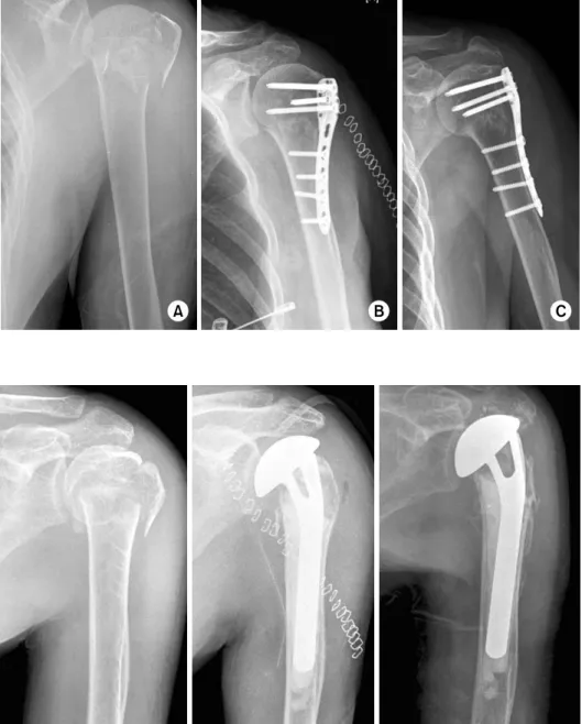 Fig. 1.  (A) The initial simple  radiograph taken in the  emer-gency room of a 54-years  old female show comminuted  proximal humerus fracture