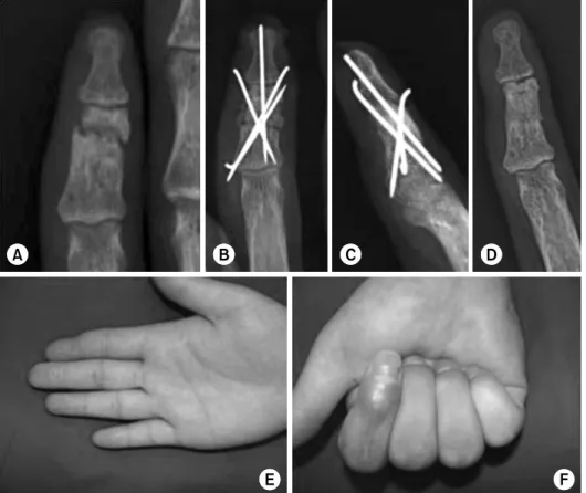 Fig. 1. A 28-year-old man  sustained middle phalanx  frac-ture of right index finger by  belt injury