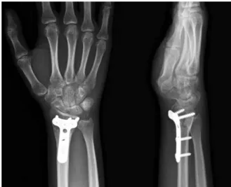 Fig. 4. Eight weeks after surgery, anteroposterior and lateral  radiographs of the right wrist show solid union.