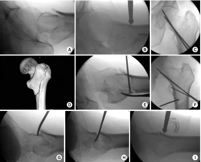 Fig. 1. Percutaneous reduction technique. 