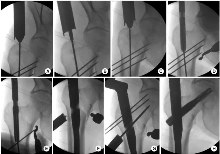 Fig. 2. Surgical Technique. 