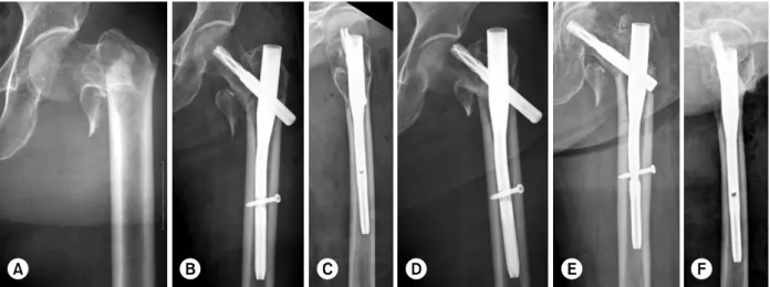 Fig. 4.  (A) Initial radiographs showed the transverse intertrochanteric fracture. 
