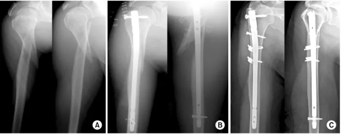 Fig. 3. Extended type, 55-year-old woman. 