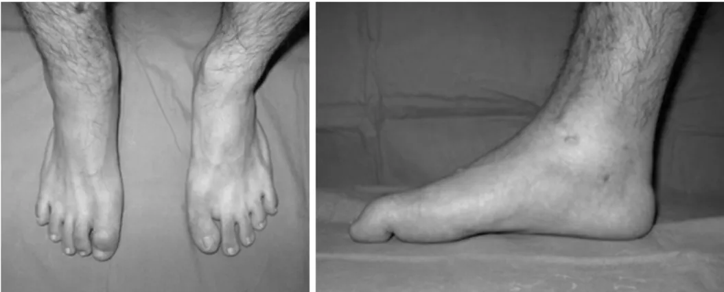 Fig. 1. Equinus of right ankle and flexion deformity of  inter-phalangeal joint of great toe.