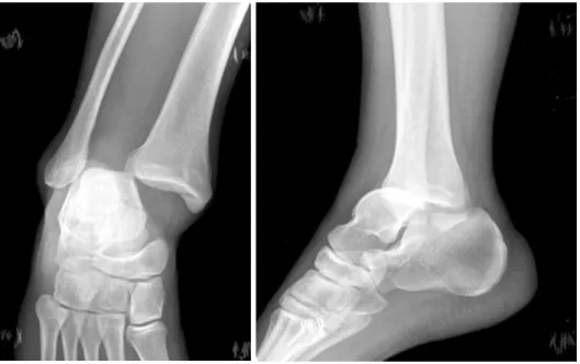 Fig. 4. (A) For initial treat- treat-ment, open reduction and  ex-ternal fixation of ankle joint  was done and a syndesmotic  screw was inserted at other  clinic