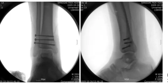 Fig. 7. Intra-operative ankle  X-ray (AP and lateral views).