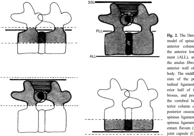 Fig. 2. The Denis three-column model of spinal injury 9) . The  anterior column consists of  the anterior longitudinal  liga-ment (ALL), anterior half of  the anulus fibrosus (AF), and  anterior wall of the vertebral  body
