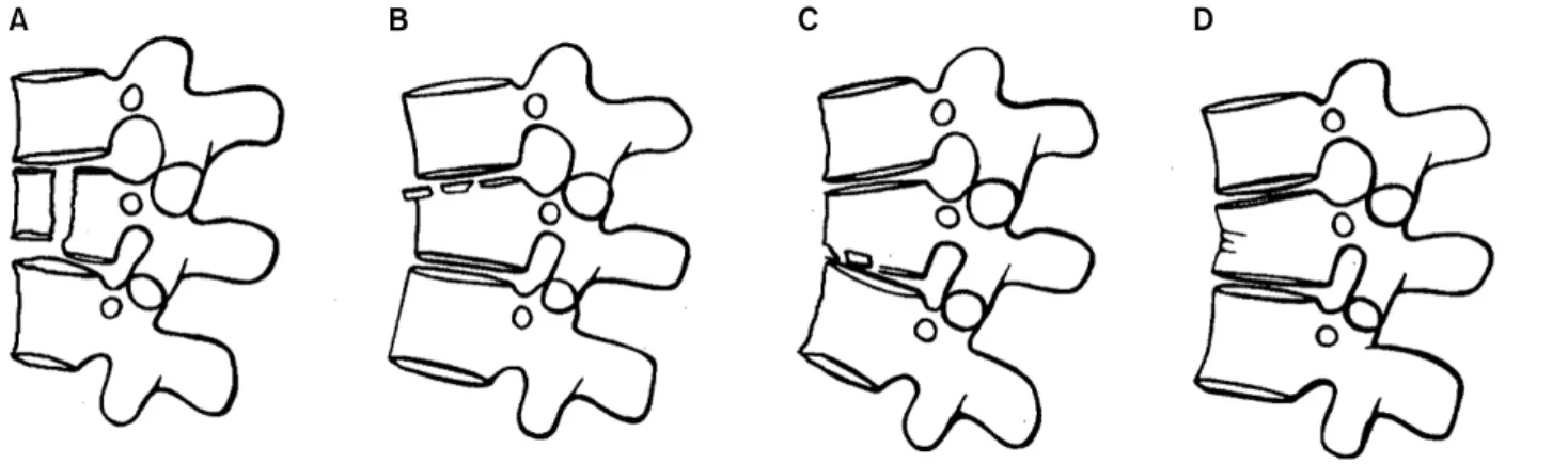 Fig. 3. Denis classification of thoracolumbar compression fractures 9) .    전방주  (anterior  column)는  전방종인대,  추체  전방  1/2, 섬유륜의  전방부로,  중간주  (middle  column)는  후방종인대, 추체  후방  1/2,  섬유륜의  후방부로,  후방주  (posterior  col-umn)는  척추경,  황색인대,  후관절  인대,  극간  인대로  구성