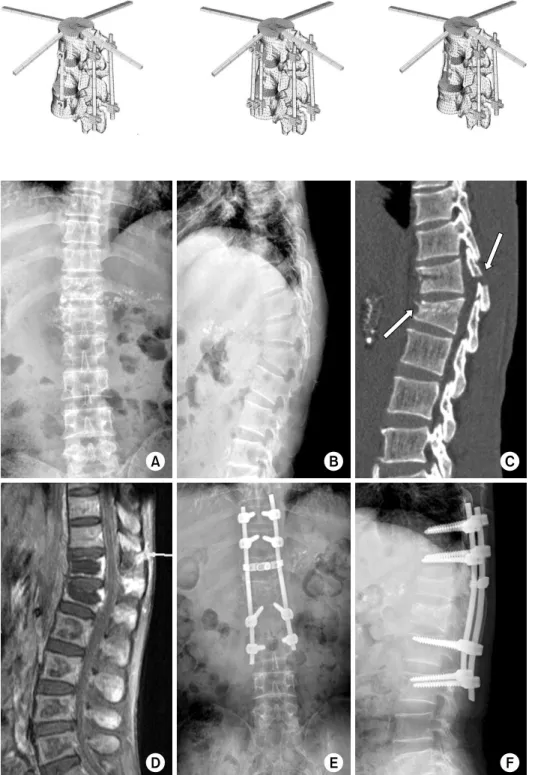 Fig. 5. The finite element  models of thoracolumbar spine segments with different  ante-roposterior fixation techniques  were developed 27) .