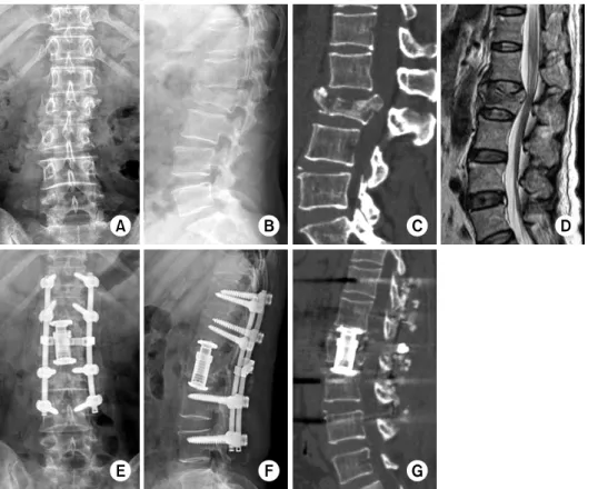 Fig. 7. A 50-year old female  got injured by a fall from  height, who was diagnosed  with incompleted paraplegia  due to the cord injury with  unstable bursting fracture at  L2  (A, B)