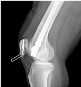 Fig. 5. Improper nail depth cause patella notching and  anterior knee pain.