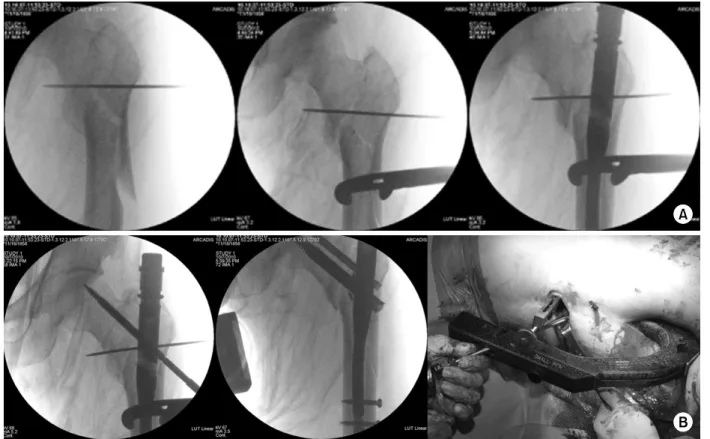 Fig. 1. Surgical technique. 