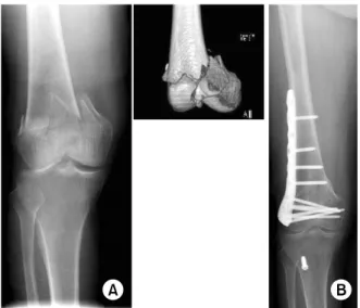 Fig. 1. (A) The initial radiographs and 3D CT of a 60-year-  old female who sustained a Type C2 supracondylar fracture  of the distal femur showing a intra-articular supracondylar  fracture.