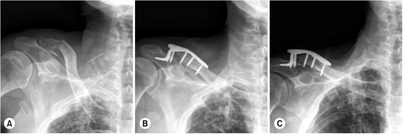 Fig. 1.  (A)  73-year-old male with a type IIb fracture of the distal clavicle. 