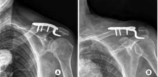 Fig. 3. (A) Clavicular fracture at the medial aspect of the  hook plate. 