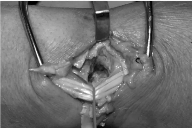 Fig. 1. Volarly dislocated lunate is seen through the space  between 3∼4 extensor compartments by dorsal approach.