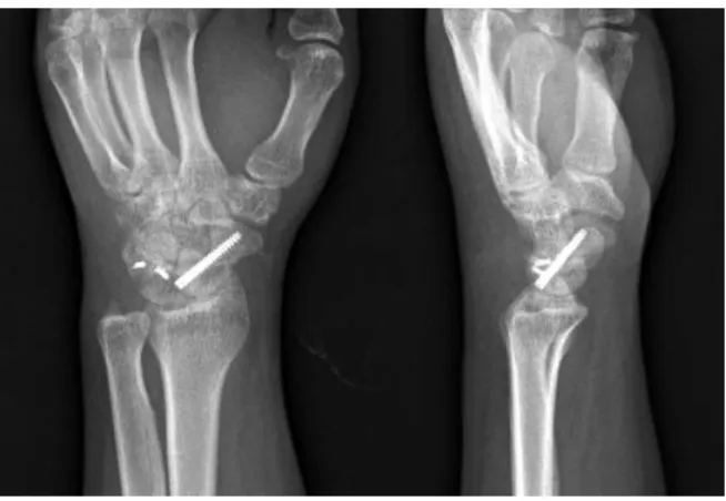 Fig. 8. The flexion-extension arch of the wrist is 130 o  14  months after surgery.