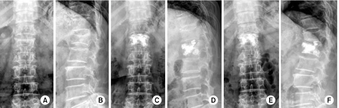 Fig. 3. A 69 year-old woman with compression fracture of L1. 