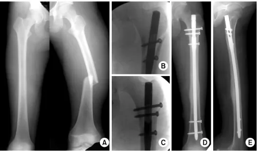 Fig. 1. (A) Initial AP view  shows AO type A3 femoral  shaft fracture and contralateral  femoral shaft