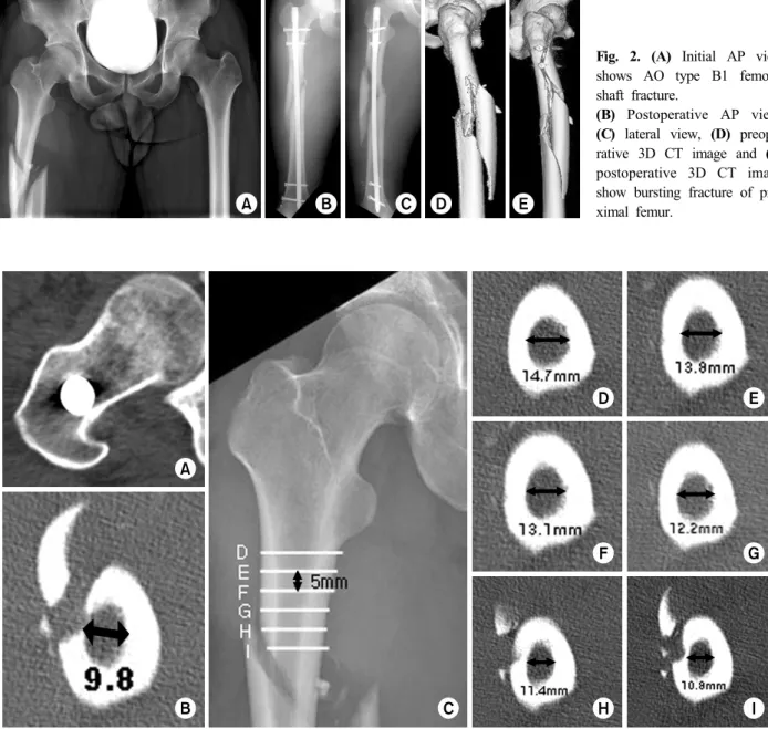 Fig. 2. (A) Initial AP view  shows AO type B1 femoral  shaft fracture. 
