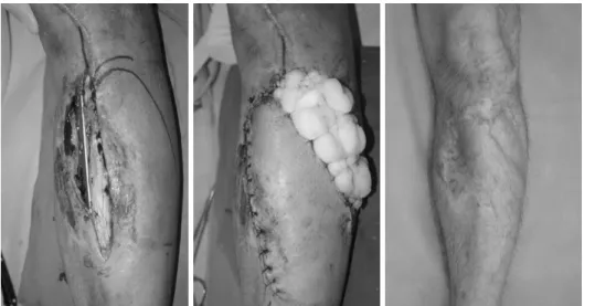 Fig. 2. Local flap.    경골의  개방성  골절  시  환부를  피복하는  방법은  다양하다.  하지만  다른  부위와는  달리  경골은  많은  부분이  피부 바로  밑에  골조직이  위치하며,  근육층이  두껍지  않고,  특히 원위  1/3은  근육이  충분치  않아  연부조직  결손이  생길  경우  재건에  어려움이  있다
