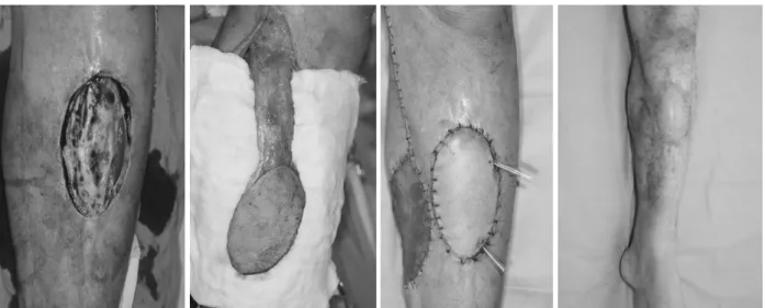 Fig. 6. Saphenous neurocutaneous flap with broad base.
