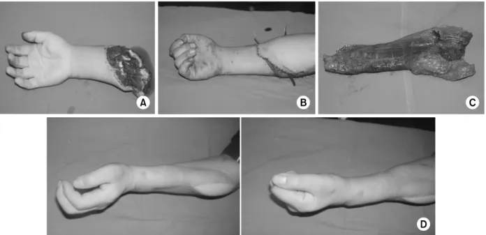 Fig. 4. (A) A 24-year-old man had a proximal forearm amputation. 