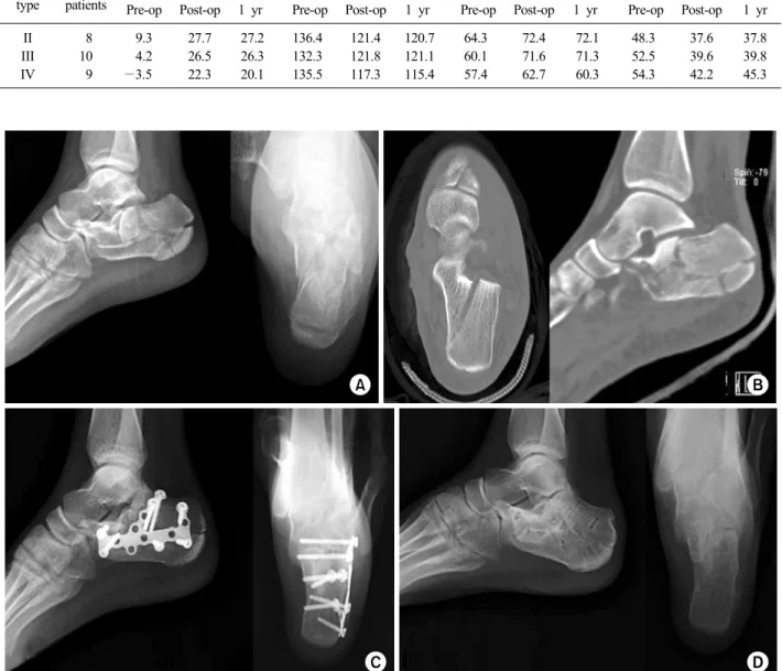 Fig. 1. A 21-year-old female patient sustained left intra-articular calcaneal fracture by slip down