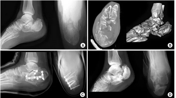 Fig. 2. A 45-year-old male patient sustained right open comminuted intra-articular calcaneus fracture by fall down from 6  meter height